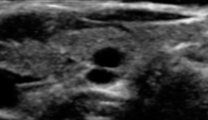 Cystic or Almost Completely Cystic