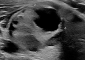 Mixed Cystic and Solid