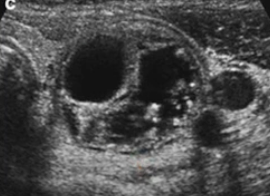 Mixed Cystic and Solid