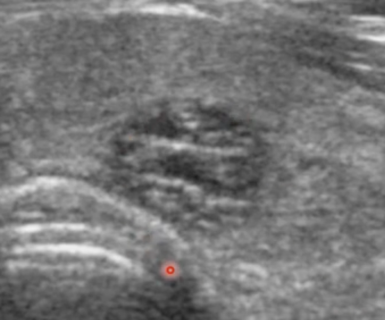 Spongiform