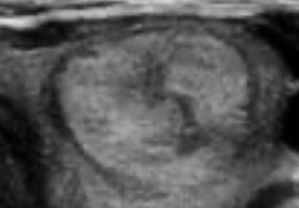 Hyperechoic or Isoechoic