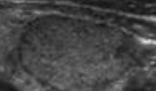 Hyperechoic or Isoechoic