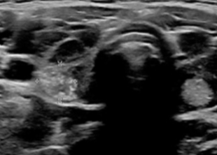 Hyperechoic or Isoechoic