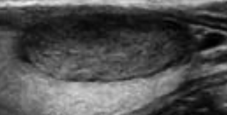 Hypoechoic