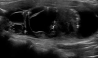 Macrocalcifications