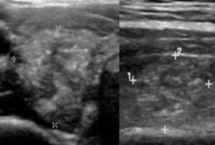 Punctate Echogenic Foci