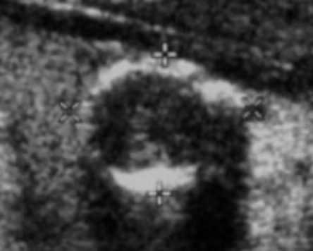Peripheral (Rim) Calcifications