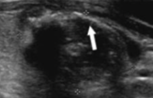 Peripheral (Rim) Calcifications