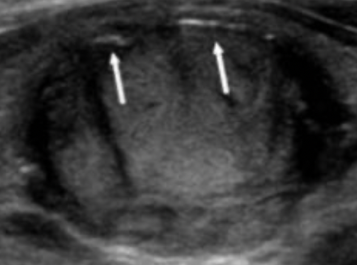 Peripheral (Rim) Calcifications