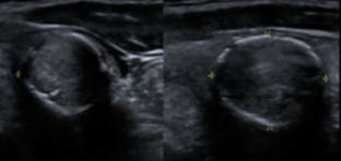 Peripheral (Rim) Calcifications