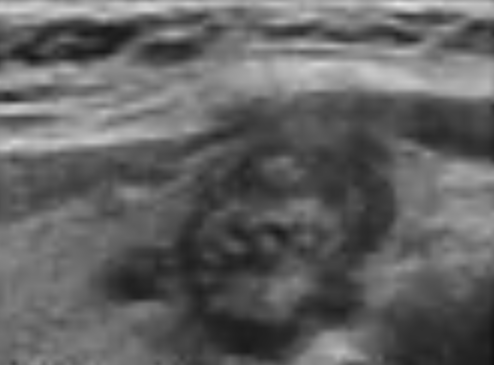 Extra-thyroidal Extension