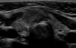 Extra-thyroidal Extension