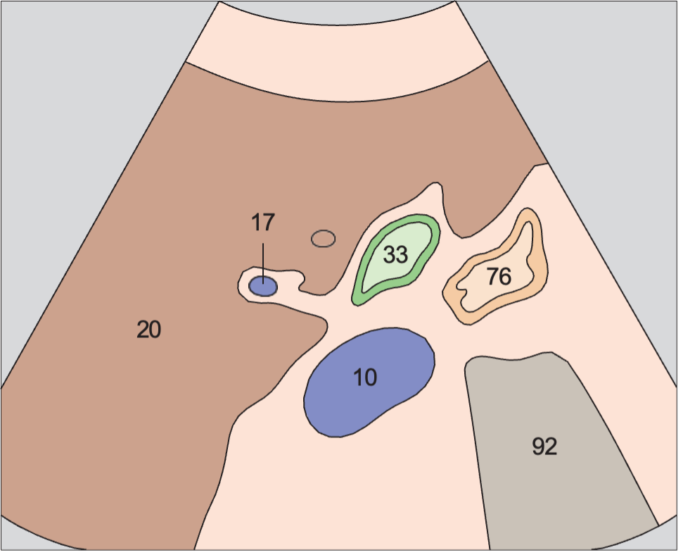 Junction of neck and body of gallbladder
