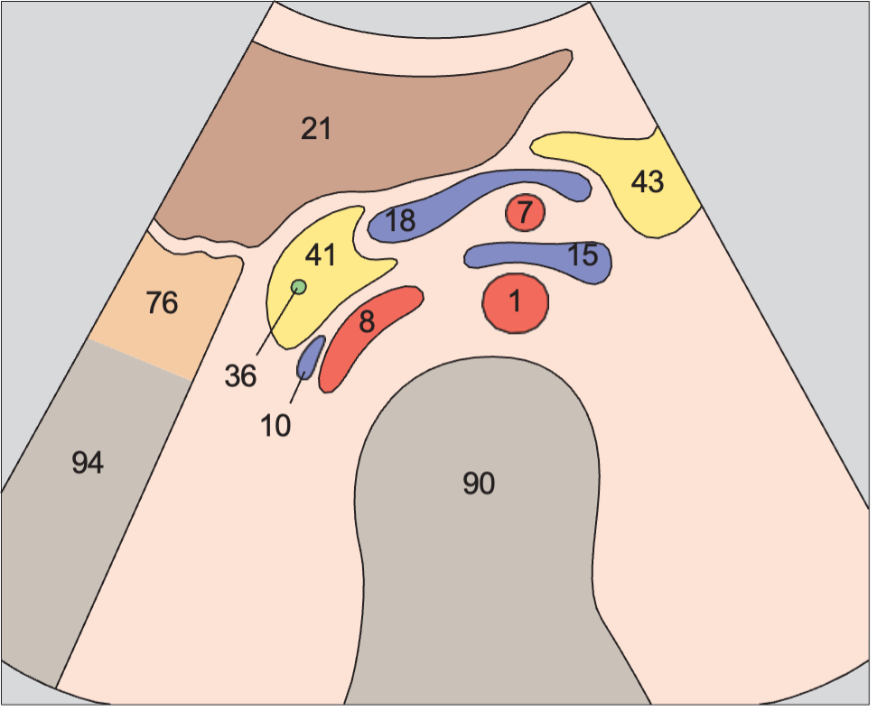 Infrarenal aorta and vena cava