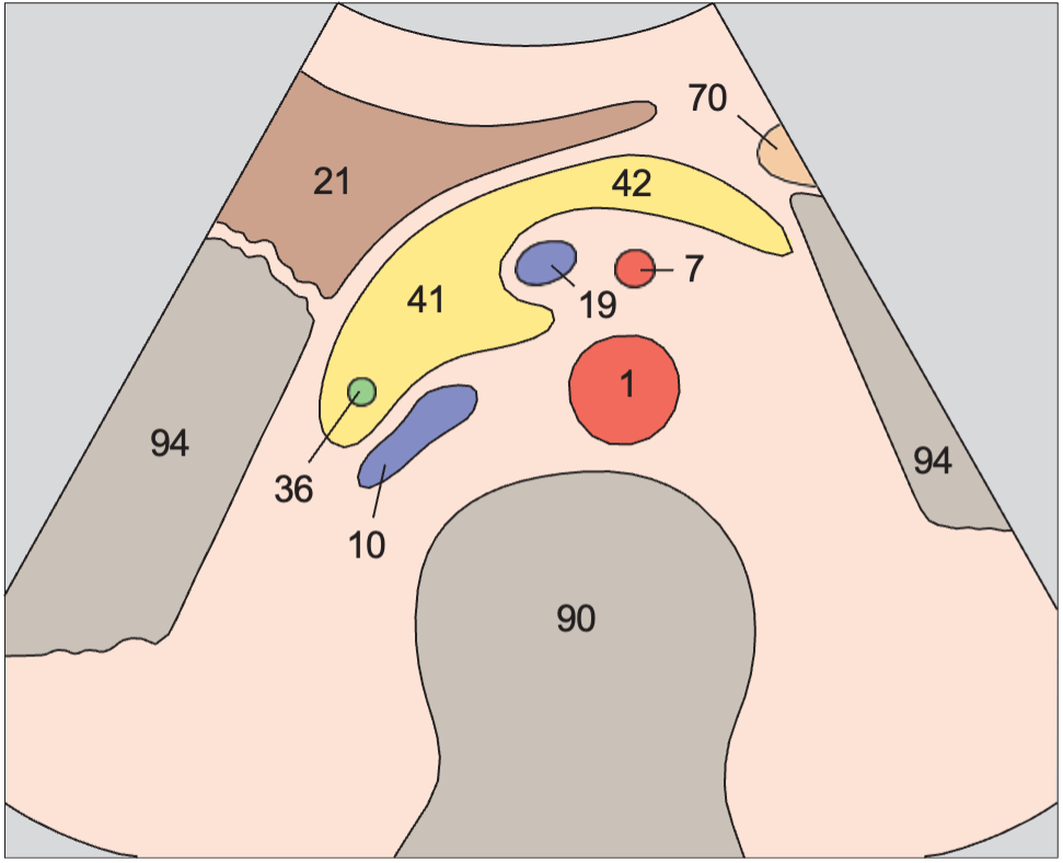 Infrarenal aorta and vena cava