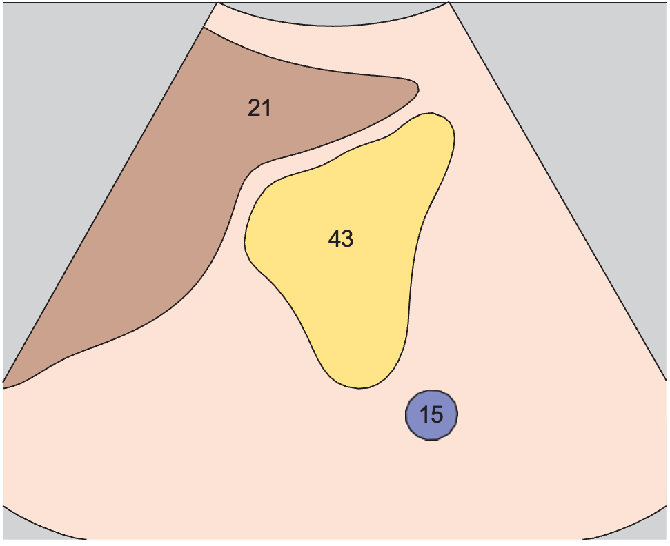 Tail of pancreas