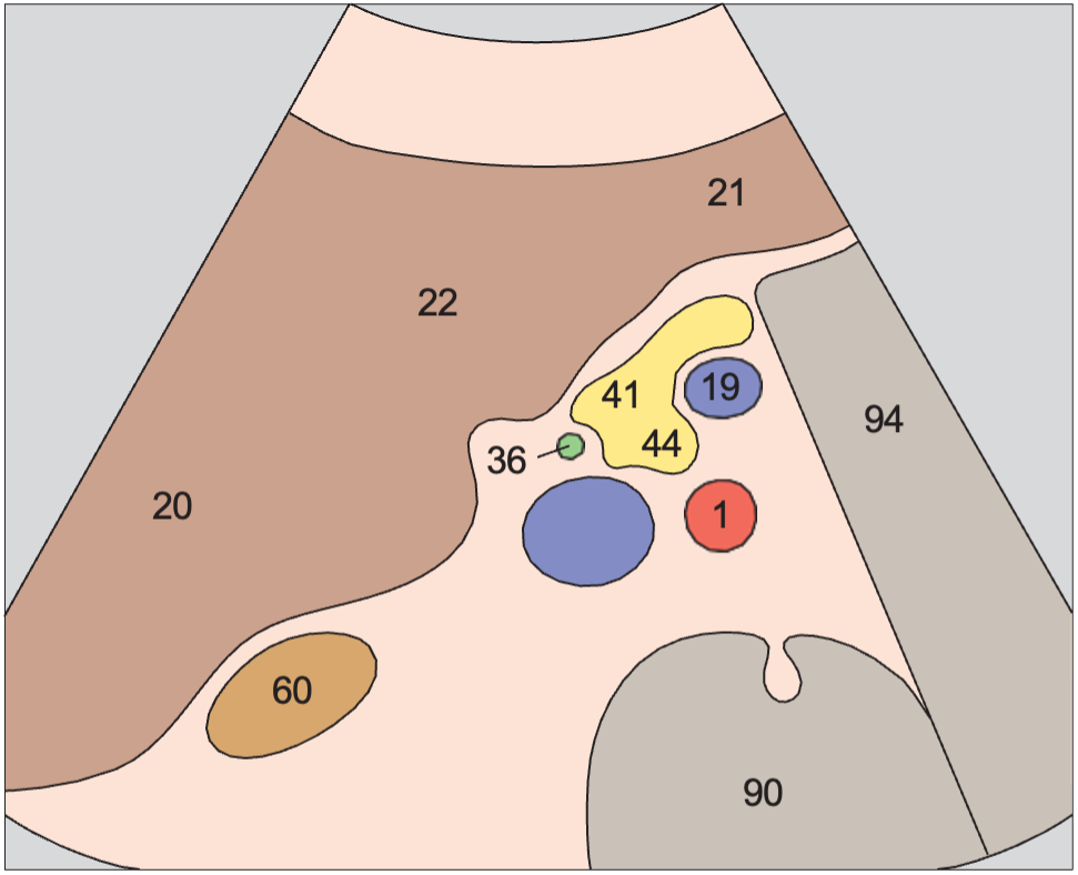 Head of pancreas, vena cava, superior mesenteric vein