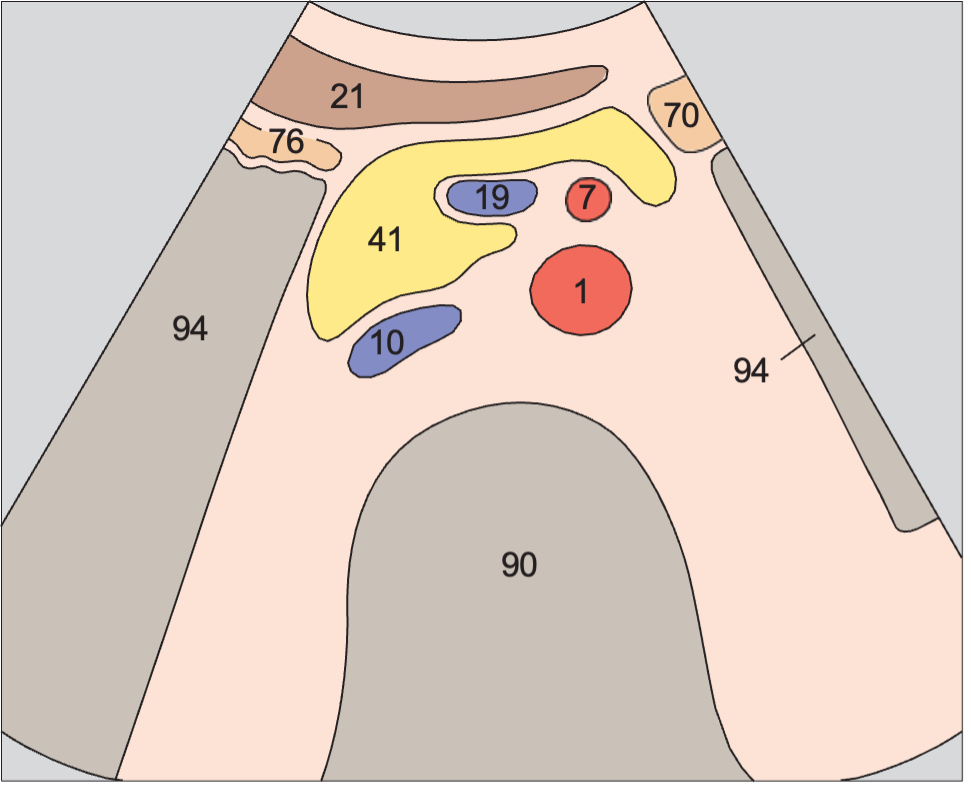 Infrarenal aorta and vena cava