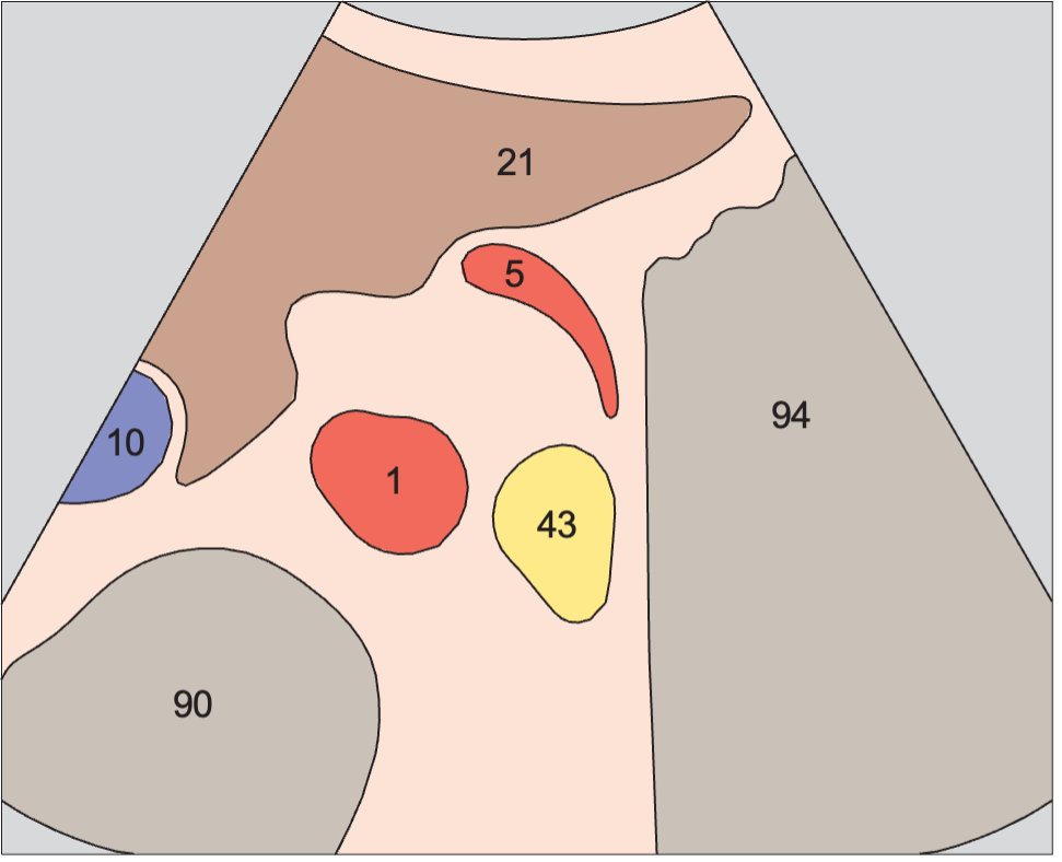 Tail of pancreas, splenic artery