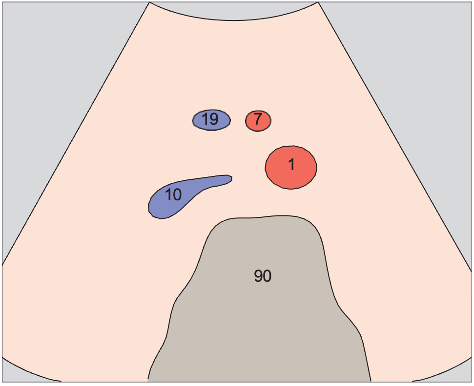 Infrarenal aorta, vena cava, superior mesenteric artery and vein