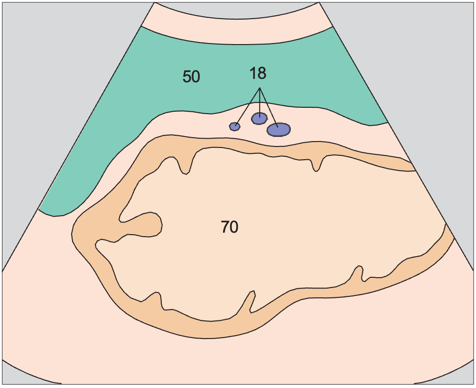 Scan anterior to tail of pancreas, spleen, stomach