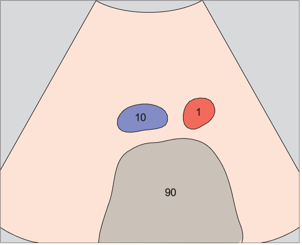 Infrarenal aorta and vena cava