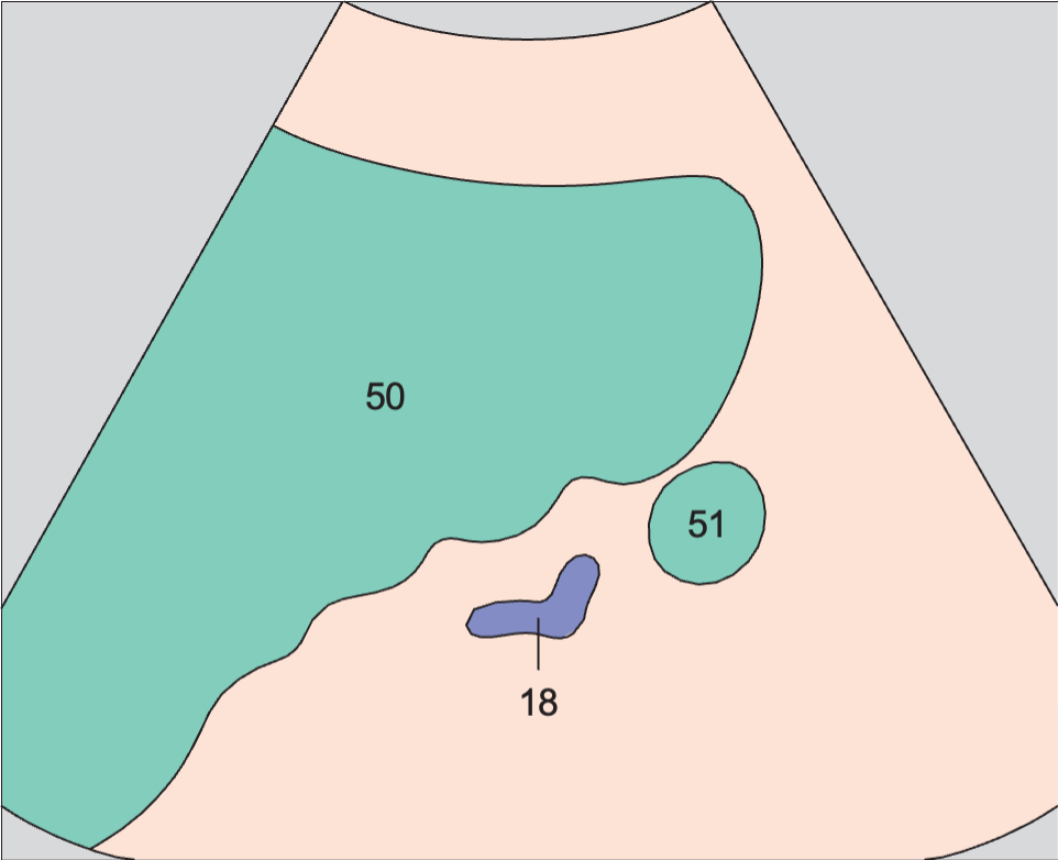 Accessory spleen