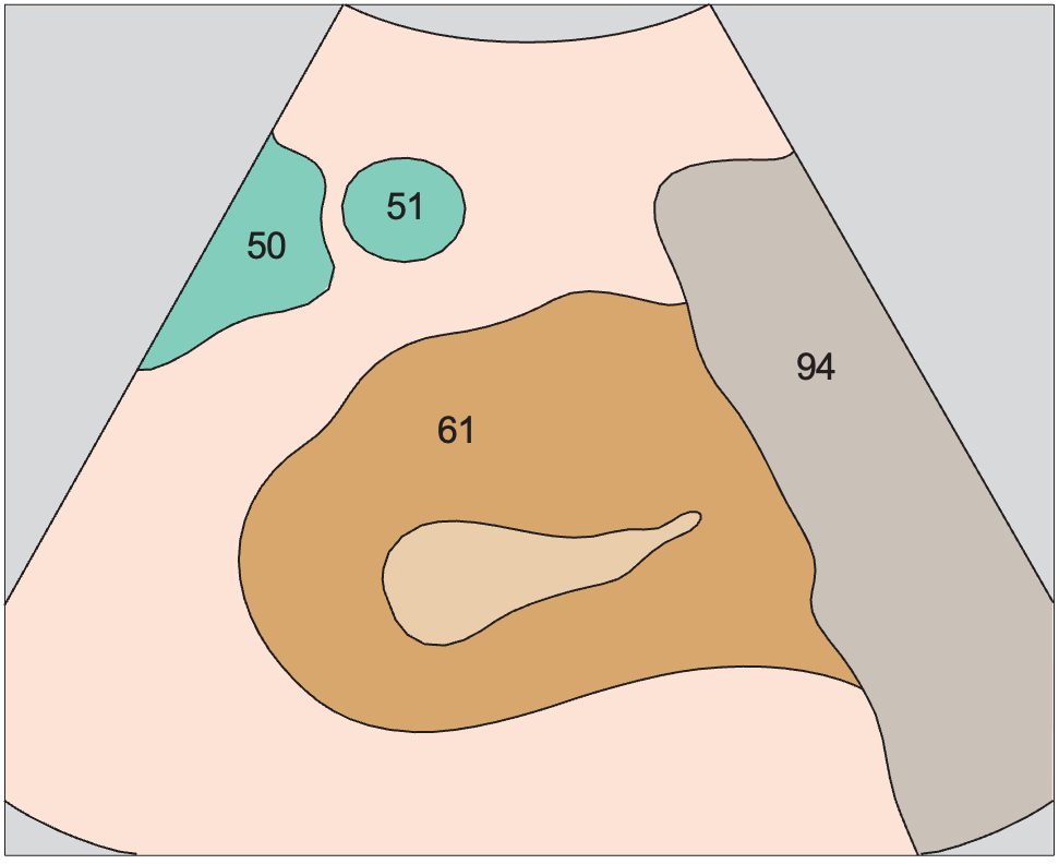Accessory spleen