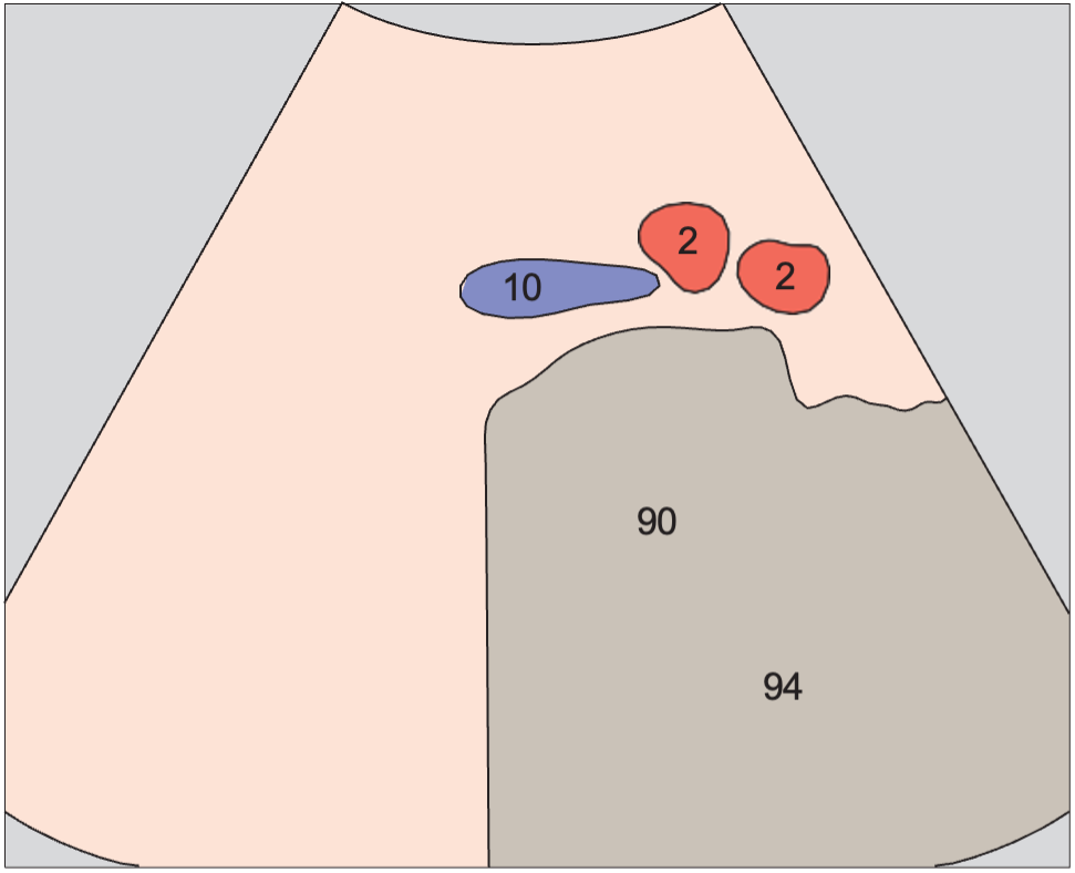 Aortic bifurcation