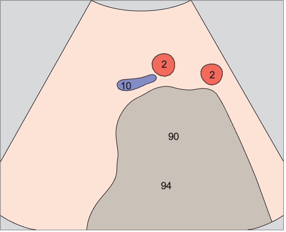 Iliac arteries