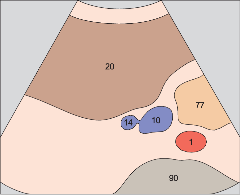 Renal vein, vena cava