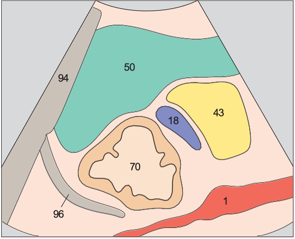 Spleen, tail of pancreas