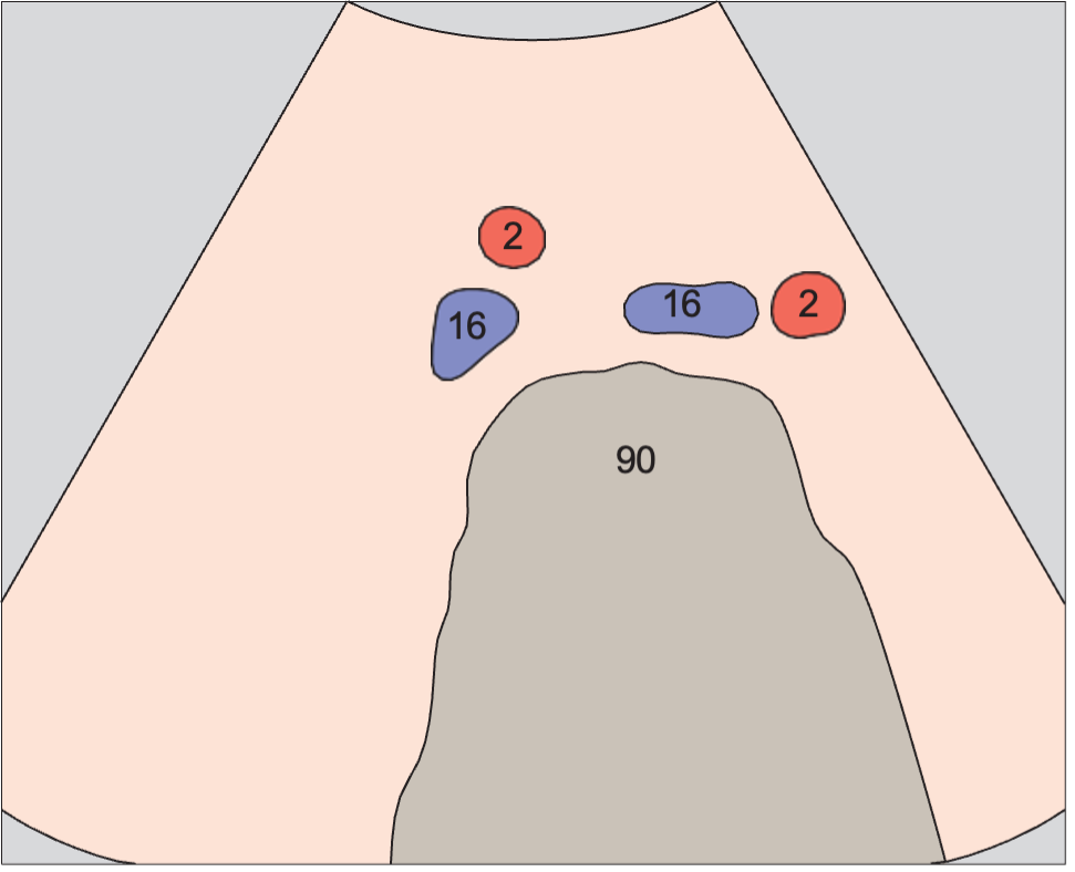 Iliac vessels
