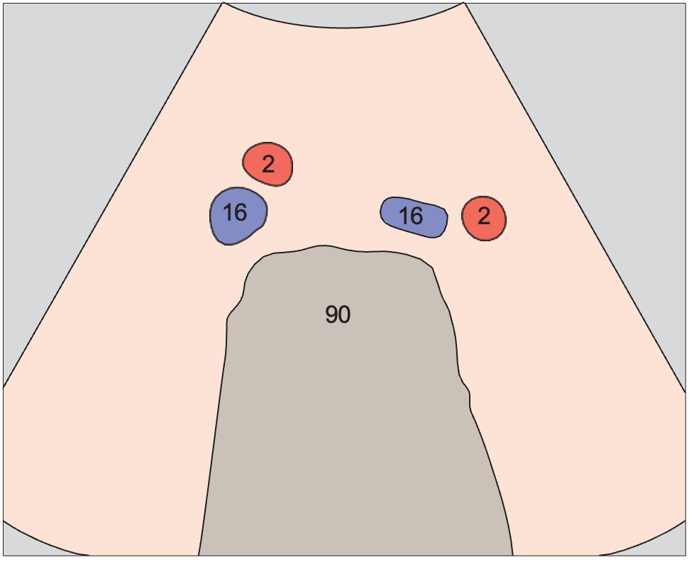 Iliac vessels