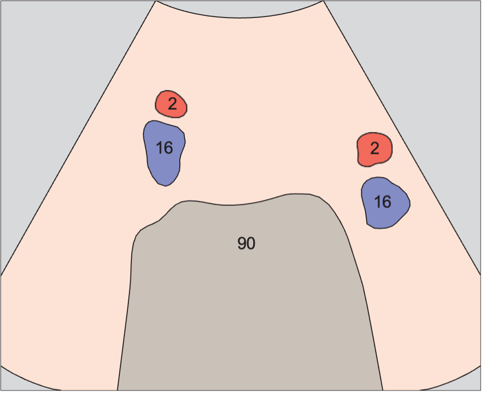 Iliac vessels