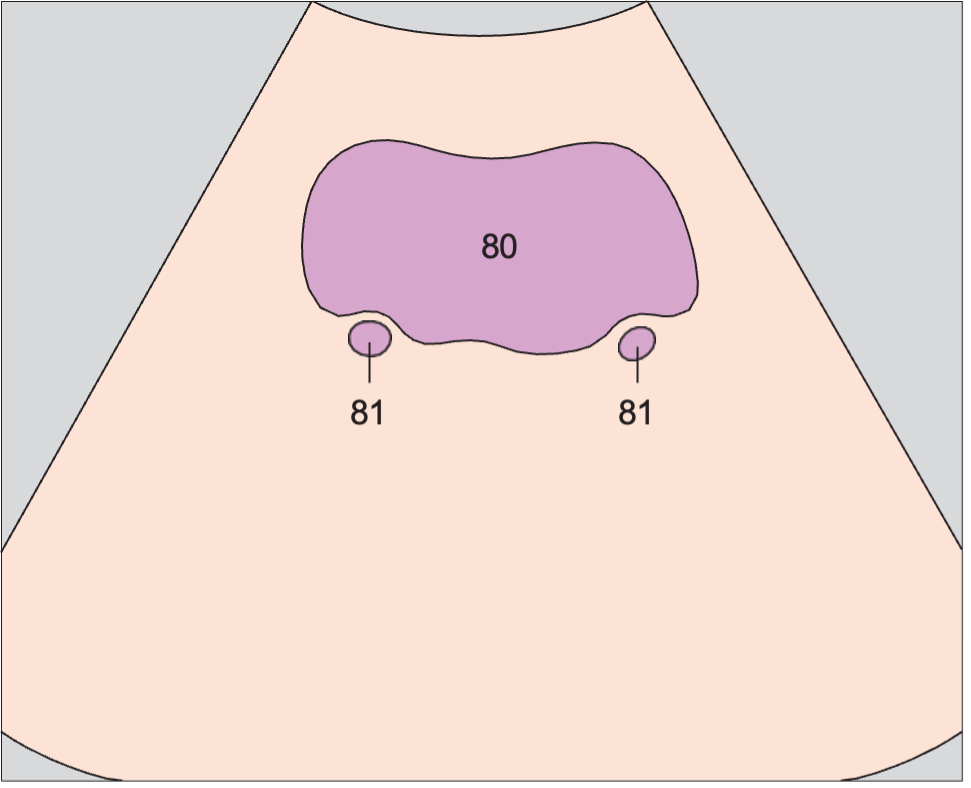 Bladder, ureteral orifices