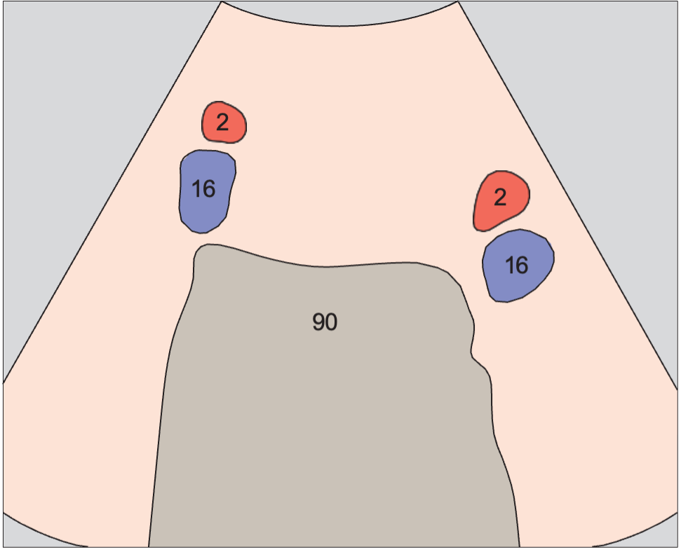 Iliac vessels