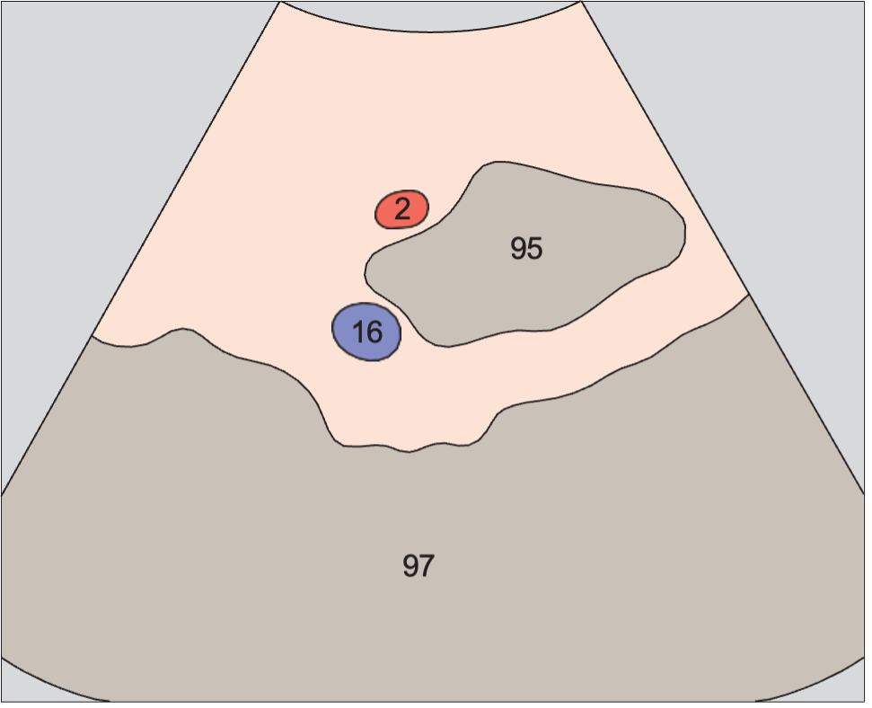 Left iliac vessels