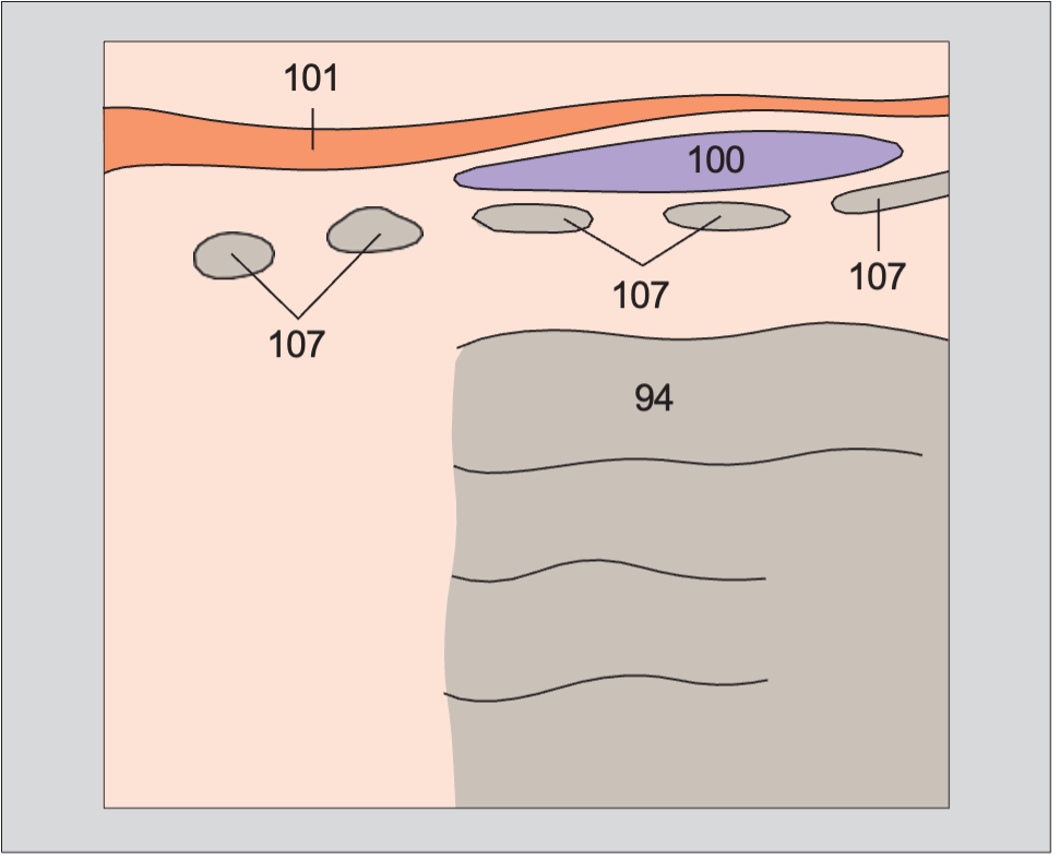 Isthmus of thyroid gland