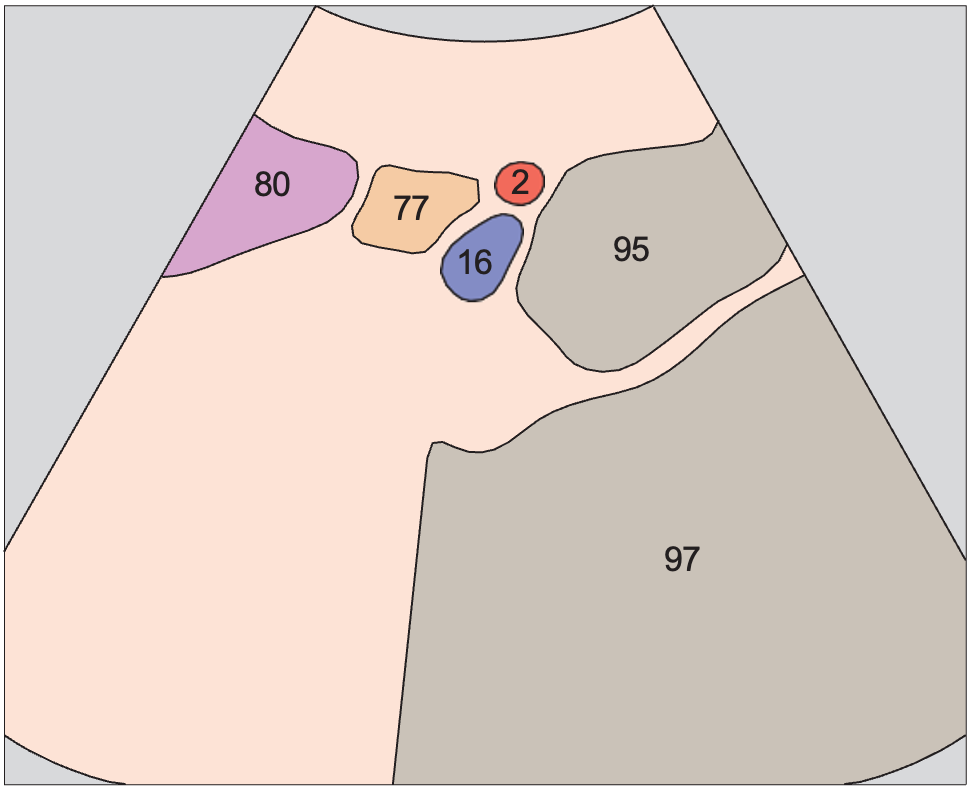 Left iliac vessels