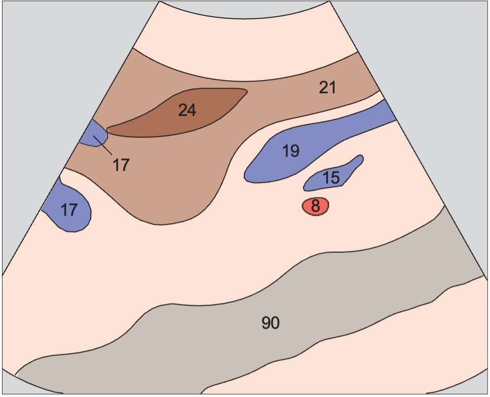 Right renal artery and left renal vein