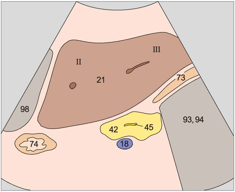 Left lobe of liver, ligamentum teres, boundary between lateral and medial segments