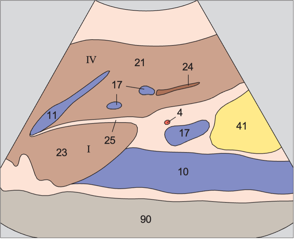 Left hepatic vein, ligamentum teres, boundary between lateral and medial segments, caudate lobe