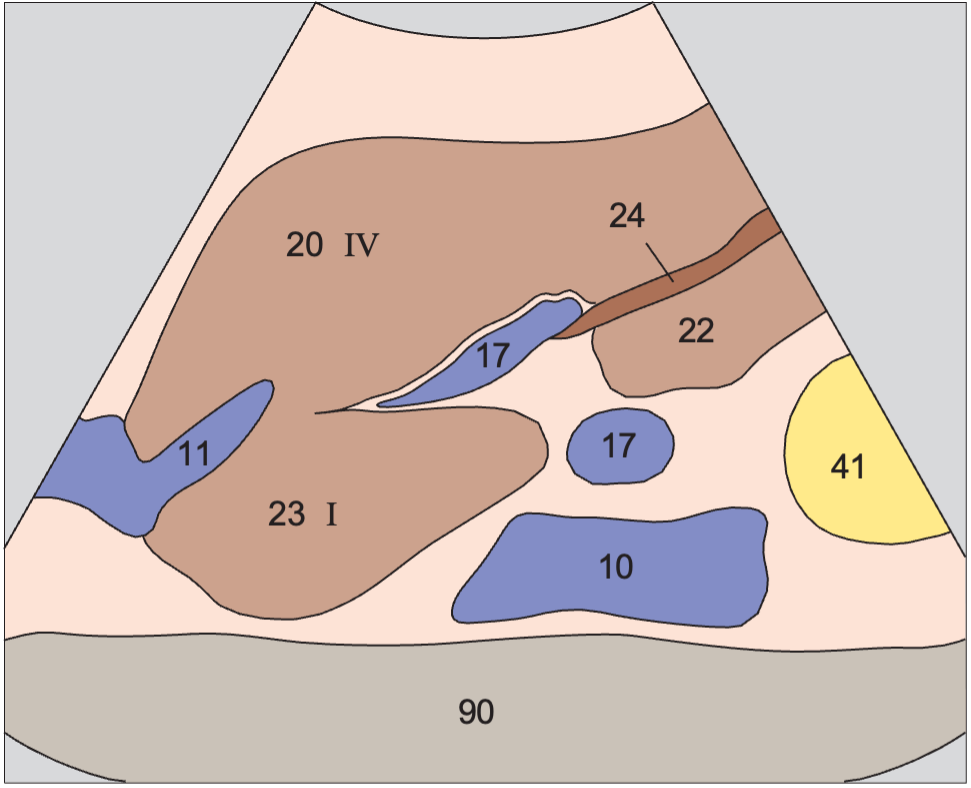 Left hepatic vein, ligamentum teres, boundary between lateral and medial segments, caudate lobe