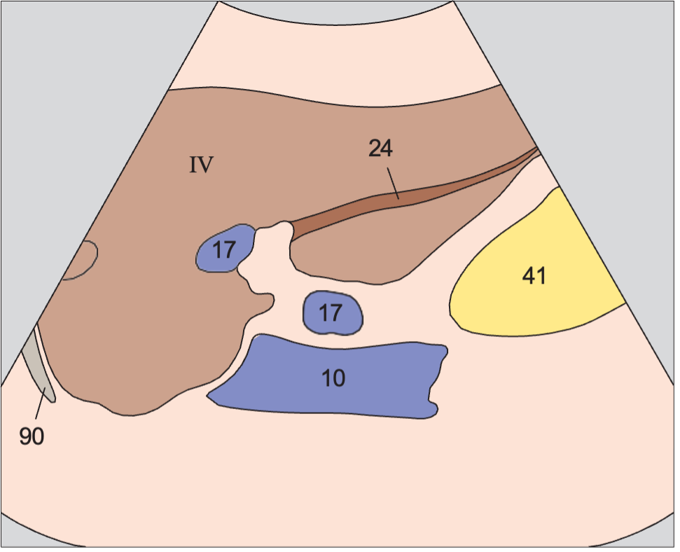Left hepatic vein, ligamentum teres, boundary between lateral and medial segments, caudate lobe