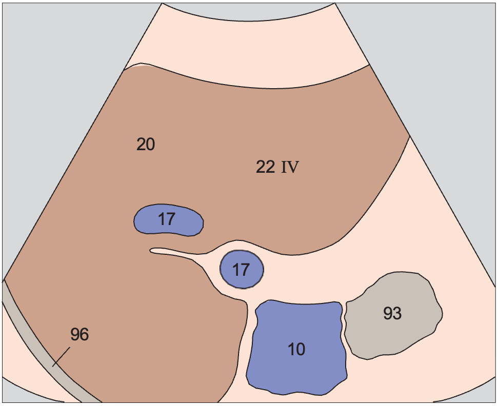 Medial segment, subsegment IV, quadrate lobe