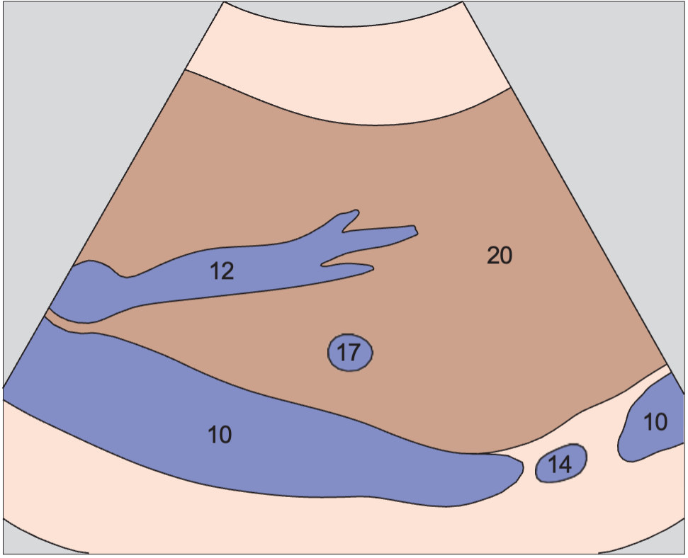 Middle hepatic vein, boundary between medial and anterior segments