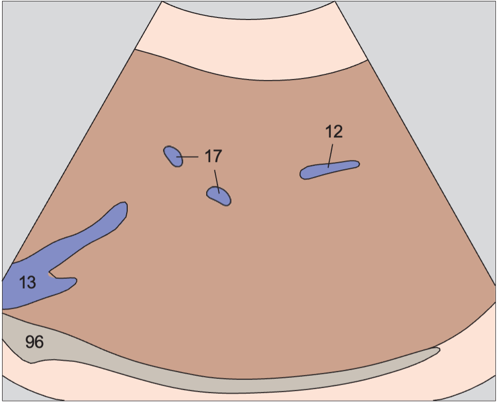 Right hepatic vein, boundary between anterior and posterior segments