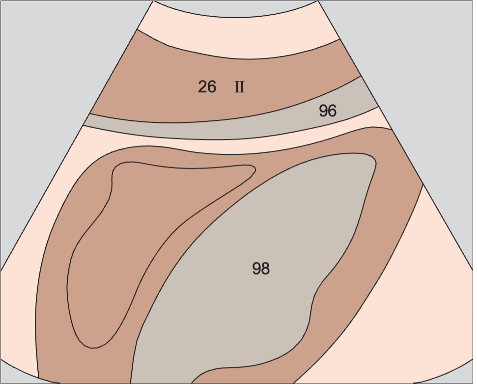 Left lobe of liver, lateral segment, heart