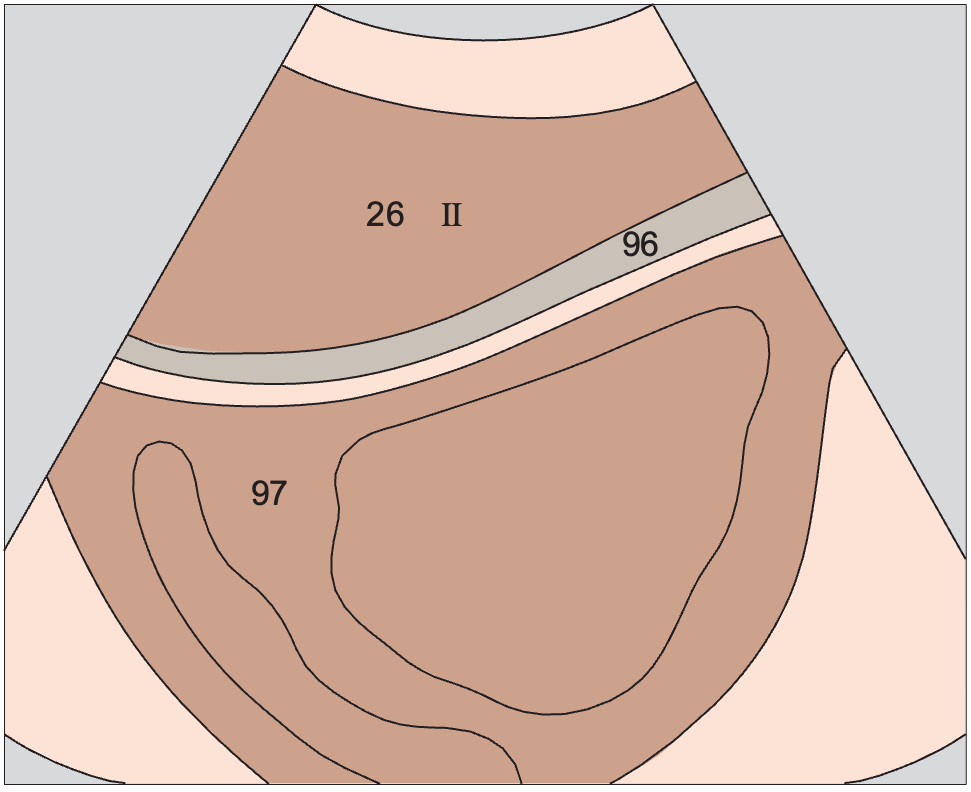 Left lobe of liver, lateral segment, heart